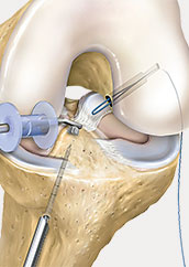 hrislanden-riss-des-vorderen-kreuzbandes-7