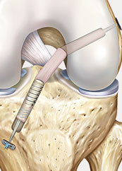 hrislanden-riss-des-vorderen-kreuzbandes-8