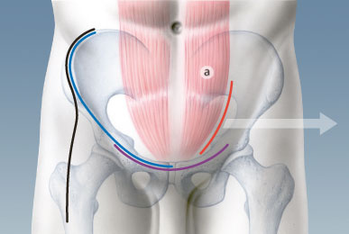 hueftgelenksrekonstruktion_pararectus_1