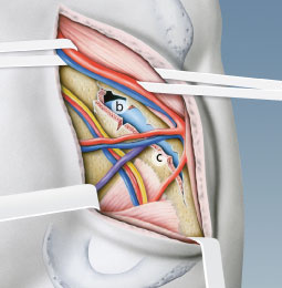 hueftgelenksrekonstruktion_pararectus_2