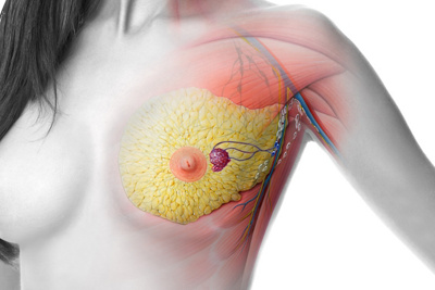 international-brustkrebs