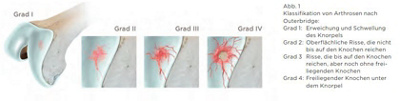 Klassifikation von Arthrosen nach Outerbridge