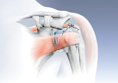 klinik-aarau-Schultergelenk-Illustration