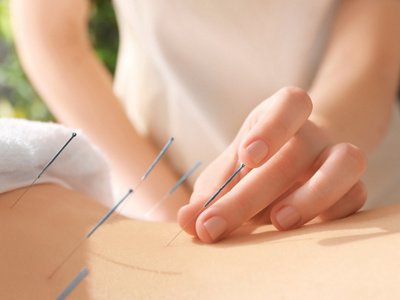 Nahaufnahme Akupunktur