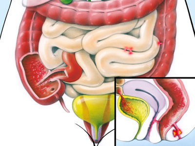 Illustration Morbus Crohn
