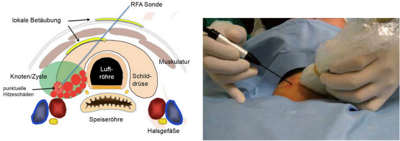 Schilddrüsenzentrum Hirslanden Thermaablation