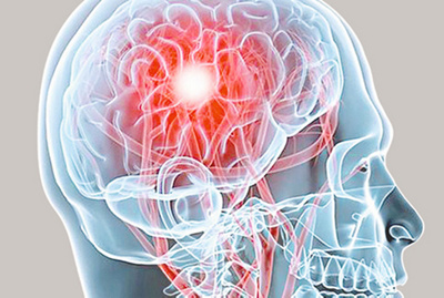 Revisionschirurgie Schlaganfall