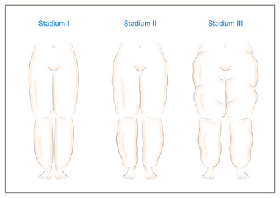 klinik-meggen-lipödem-stadien