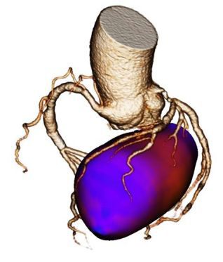 Darstellung der Koronaranatomie sowie der Durchblutung des Herzens im Rahmen einer Hybriduntersuchung. Nachweis einer sehr grossen Minderdurchblutung (blaues Areal) aufgrund einer Stenose (Verengung) im Bereich der vorderen Koronararterie.