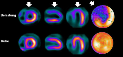 Nachweis einer sehr grossen Durchblutungsstörung (blaues Areal mit weissen Pfeilen) unter einer medikamentösen Herzbelastung im Vergleich zum normal durchblutendem Herzmuskelgewebe in Ruhe (gelb).