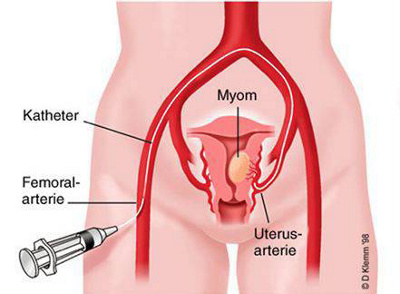 Mit der Uterusmyom-Embolisation können Myome in der Gebärmutter minimalinvasiv behandelt werden.