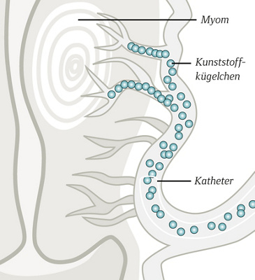 Bei der Uterusmyom-Embolisation wird ein Katheter bis zum Myom vorgeschoben. Durch das Einspritzen von winzigen Kunststoffkügelchen wird das Myom verödet.