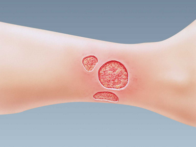 Arterielles Unterschenkelgeschwür