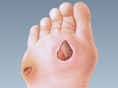 Diabetische Fusswunde