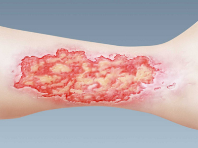 Venöses Unterschenkelgeschwür