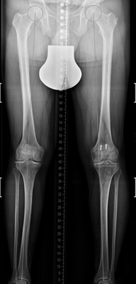 kniechirurgie-1-ganzbeinstandaufnahme