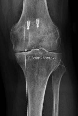 kniechirurgie-2-traglinie