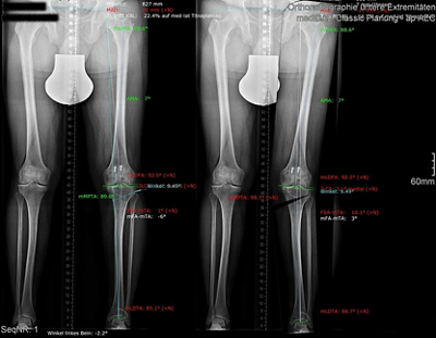 kniechirurgie-3-planung