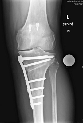 kniechirurgie-4-kontrolle