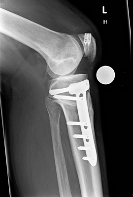 kniechirurgie-5-kontrolle