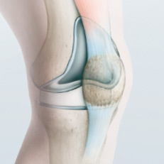 kniegelenkprothese_kunstgelenk