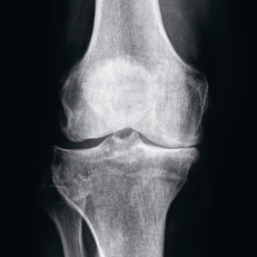 kniegelenkprothese_roentgenbild