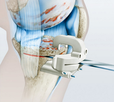 kniegelenkprothese_schnittblock