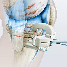 kniegelenkprothese_schnittblock_klein