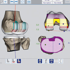 kniegelenkprothese_screen