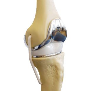 knieprothese-computer-statt-arzt-1