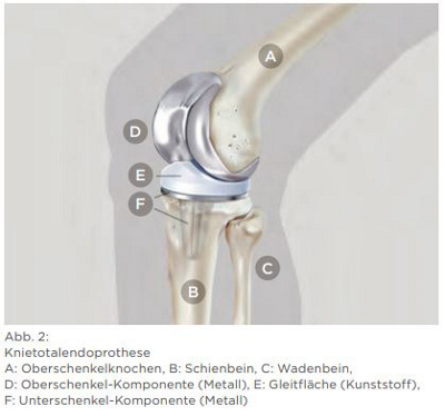 Knietotalendoprothese