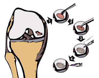 knorpelschaeden-am-knie-1