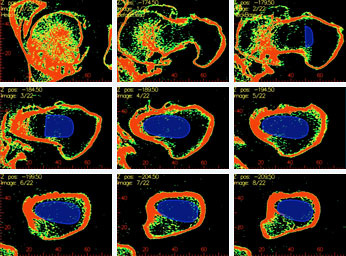 kuenstliche-hueftgelenke-nach-mass-1