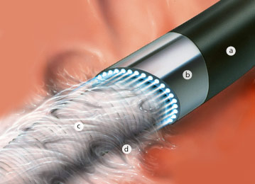 laser-elektrodenextraktionssystem-2