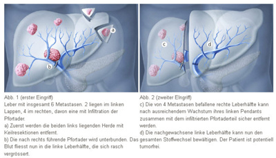 leberkrebs_grafiken_eingriff_1