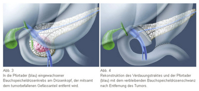 leberkrebs_grafiken_eingriff_2