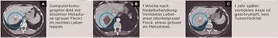 lebermetastasen-veroedet