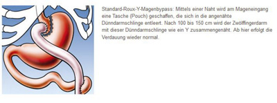 magenbypass-illustration