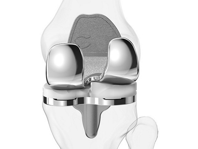 massgeschneiderte_knieprothese