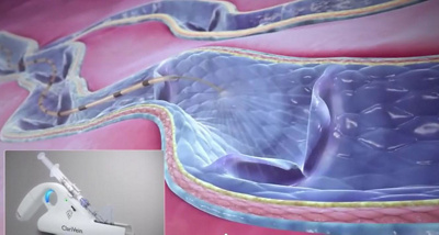 mechano-chemische ablation