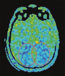 messung_hirndurchblutung