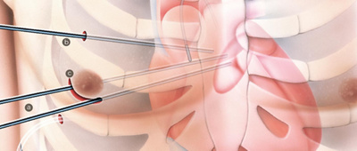 minimalinvasive_mitralklappenrekonstruktion_arbeitszugaenge
