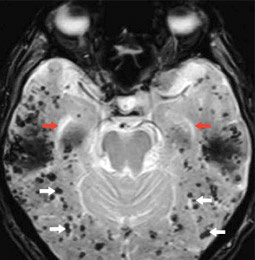 mri_alzheimer_gefaesserkrankung