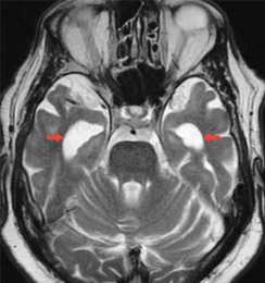 mri_alzheimer_typisch