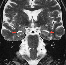 mri_alzheimer_untypisch