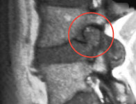 mri_bandscheibenvorfall