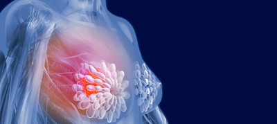 Breast cancer: the benefits of neo-adjuvant therapy