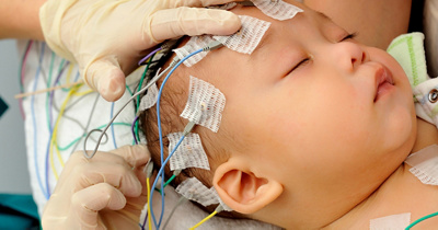 Epilepsy surgery for children