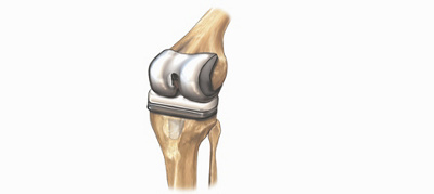 Nuwe Knie
