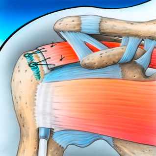 orthopaedie-zentrum-zuerich-fixation-sehne